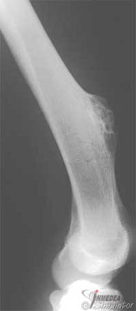 Osteochondrom Osteochondrom