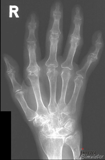 Rheumatoide Arthritis