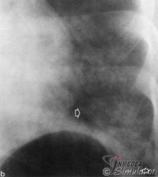 (Bildquelle: Voegeli. Praktische Thoraxradiologie)