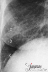 (Bildquelle: Voegeli. Praktische Thoraxradiologie)