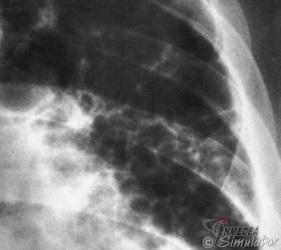 (Bildquelle: Voegeli. Praktische Thoraxradiologie)