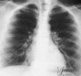 (Bildquelle: Voegeli. Praktische Thoraxradiologie)